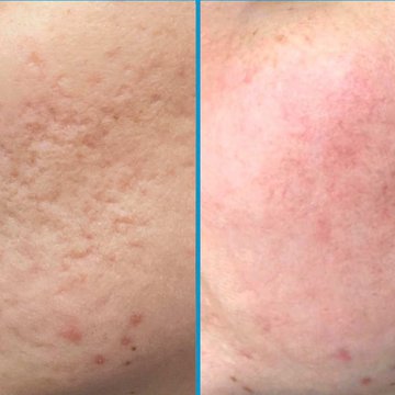 со2 шлифовка рубцов Тимченко.jpg