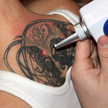 удаление-татуировки-лазером.jpg